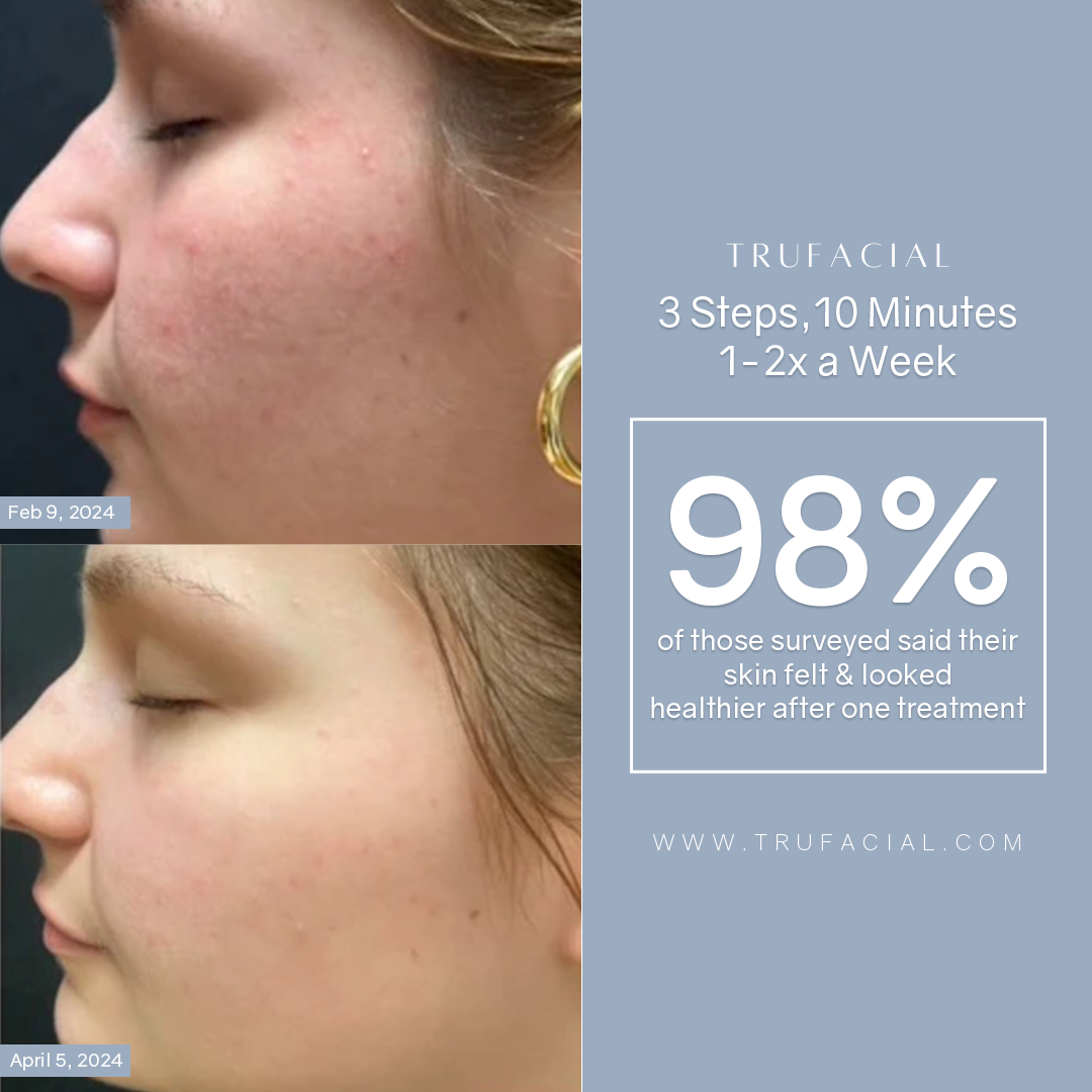 Trufacial Starter Systems