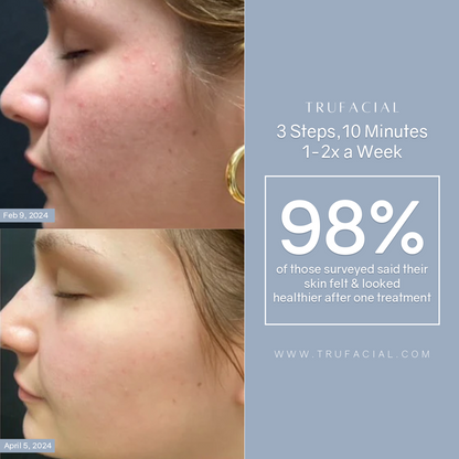Trufacial Starter Systems